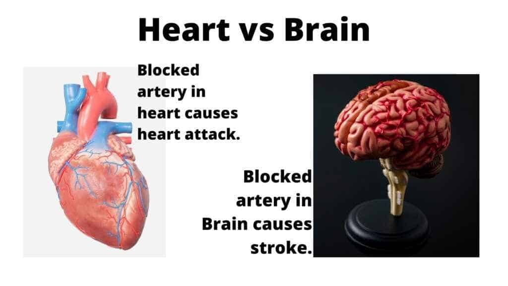 heart attack vs stroke
